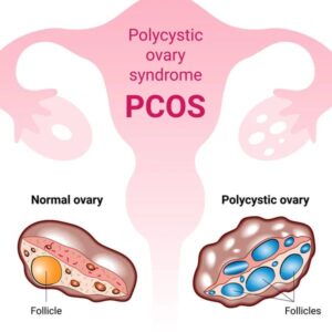 pcos advance