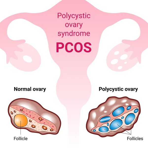 pcos advance